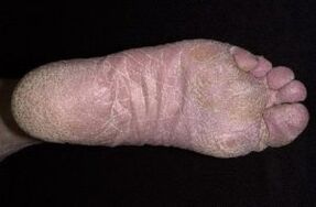 Signes et symptômes de champignons sur les jambes