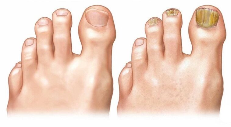 Nails dans des ongles sains et infectés