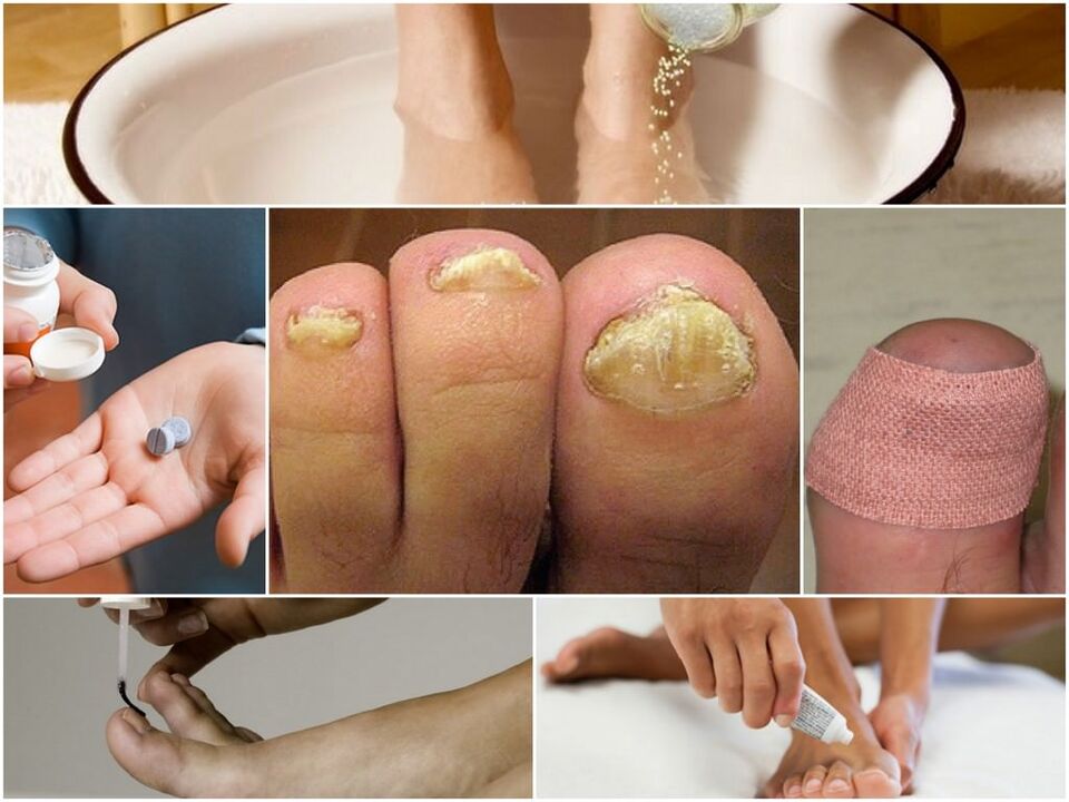 Traitement du champignon des ongles