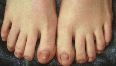 Phase de développement du champignon des ongles