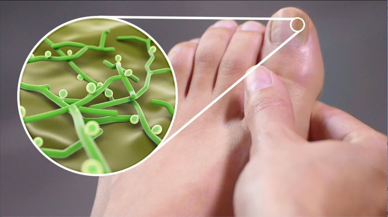 agents pathogènes des champignons des ongles des pieds