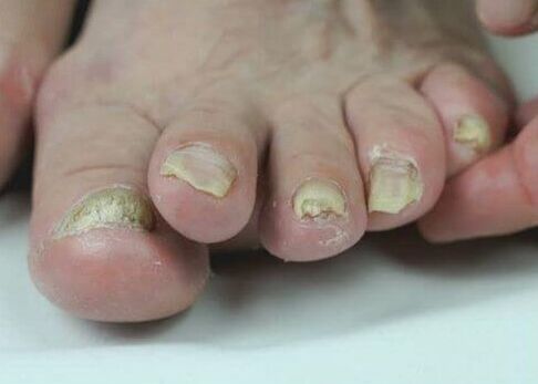 traitement des mycoses des ongles avec des médicaments