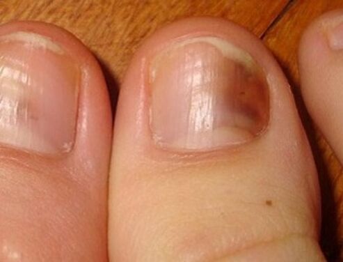 symptômes de mycose des ongles des pieds